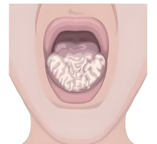 口腔白斑病例特点以及治愈时间