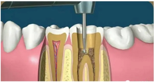什么是门牙根管治疗，门牙根管治疗的步骤是什么?