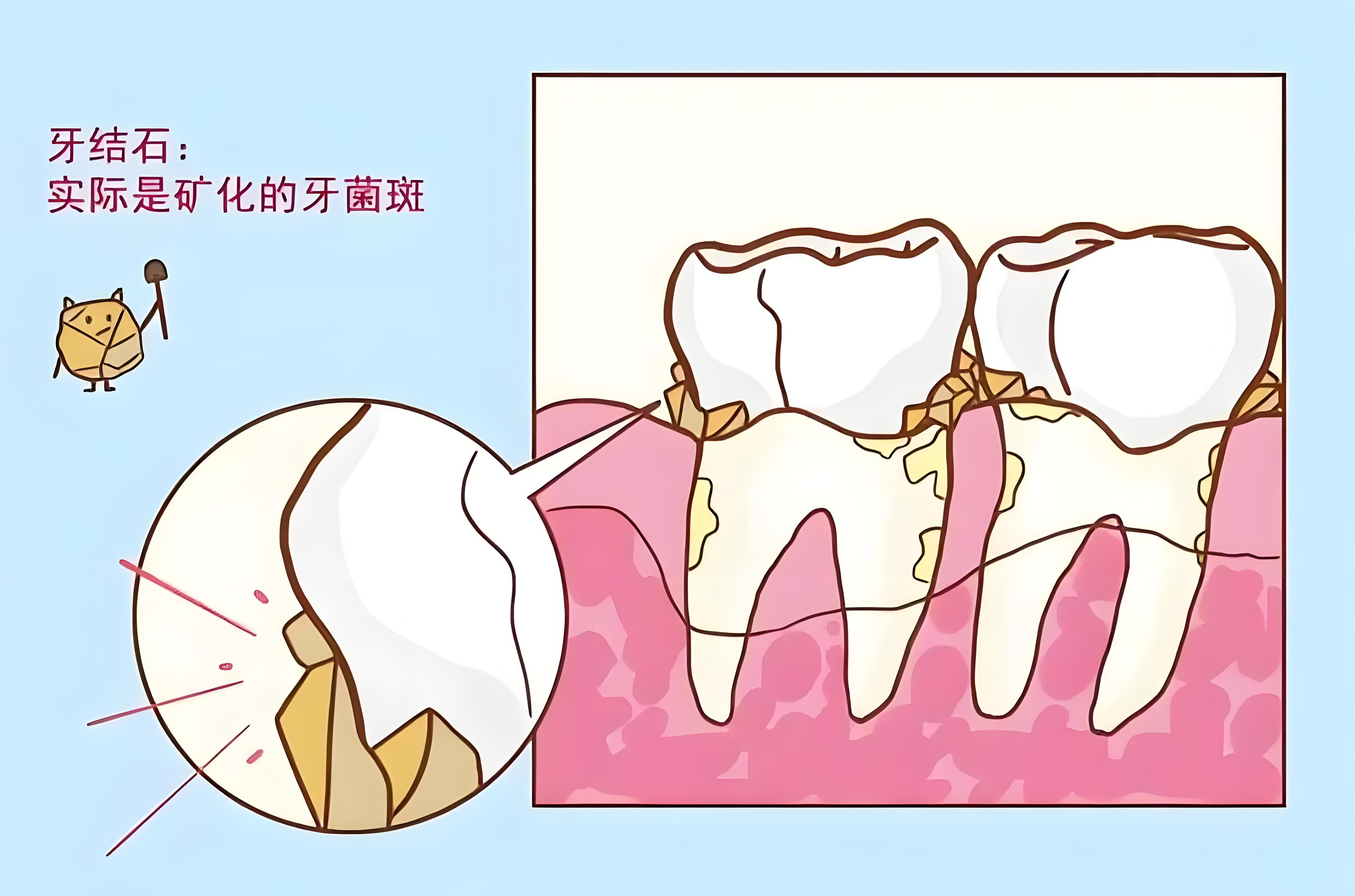 如何预防牙结石的形成呢