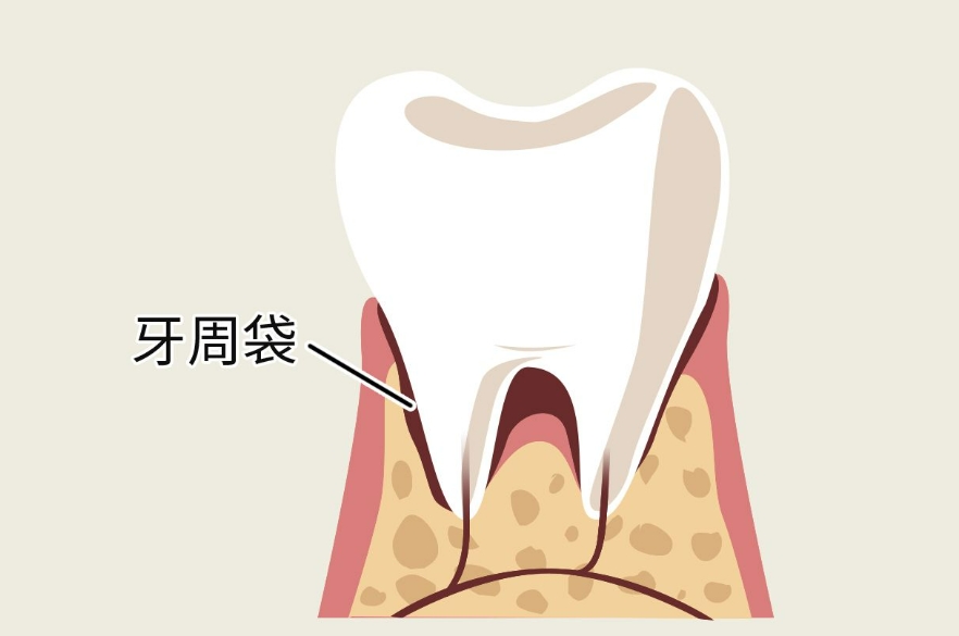 如何预防牙周袋的形成？