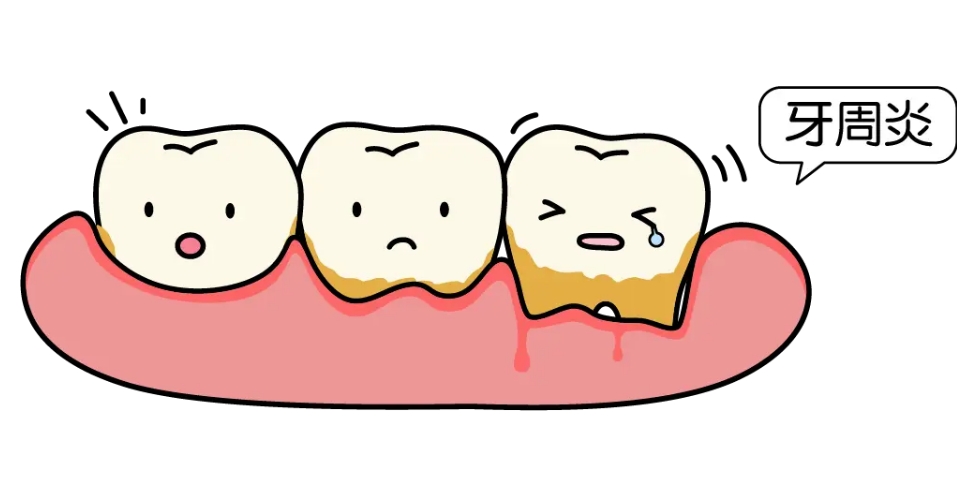 牙周炎犯了怎么快速解决？