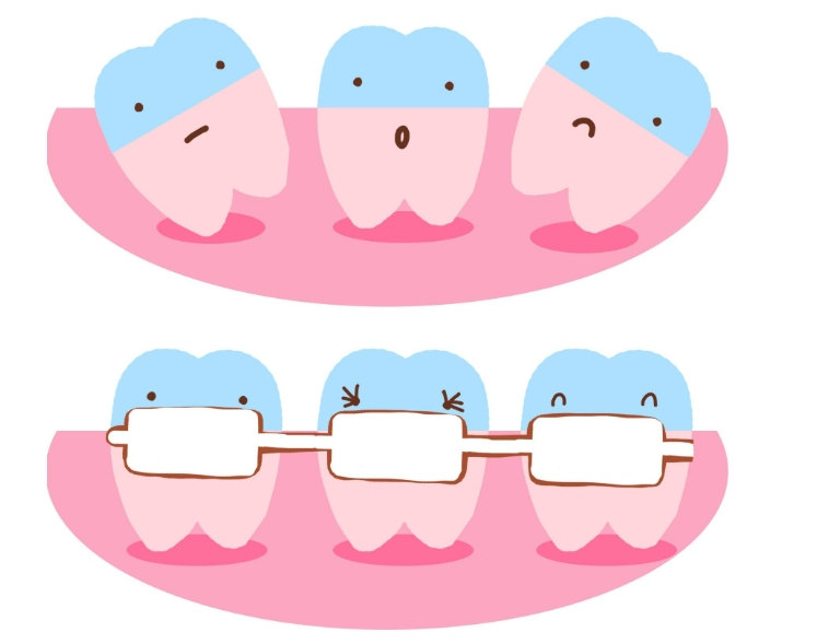 矫正牙齿有哪些矫正方式？哪种性价比高些？