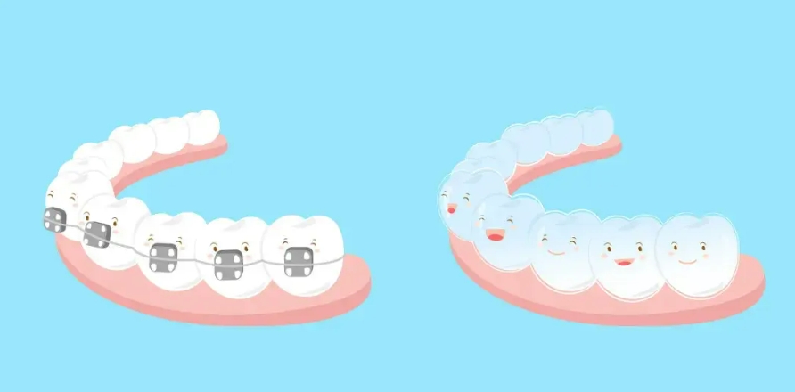 隐形矫正牙齿的优缺点是什么？