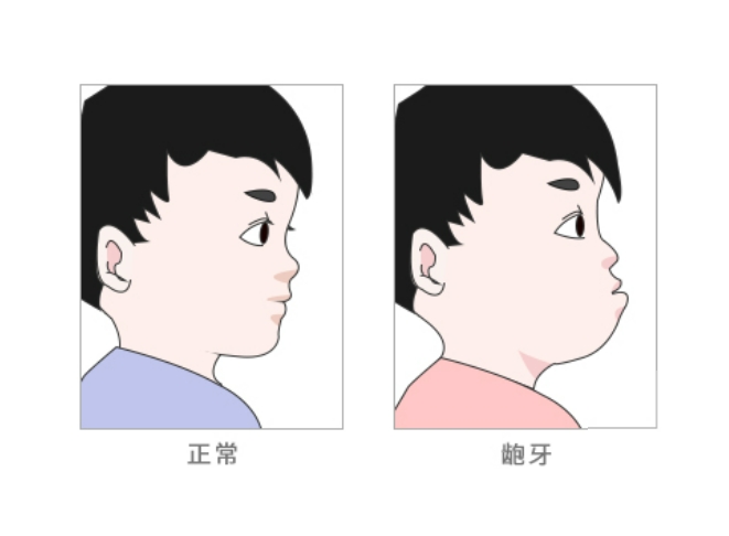 龅牙有哪几种类型，矫正方式一样吗