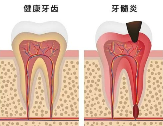 什么是牙髓炎,它有什么症状？